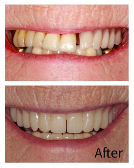 Dental Implants Blackheath - Case 1 | Artisan Implants